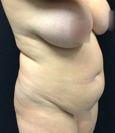 Tummy Tuck Before & After Gallery - Patient 72237389 - Image 3