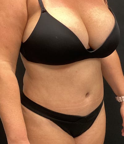 Tummy Tuck Before & After Gallery - Patient 72237389 - Image 4