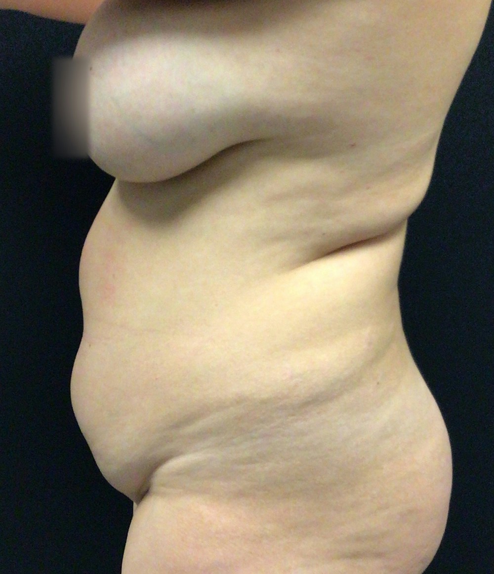 Lipo 360 Before & After Gallery - Patient 72237404 - Image 5