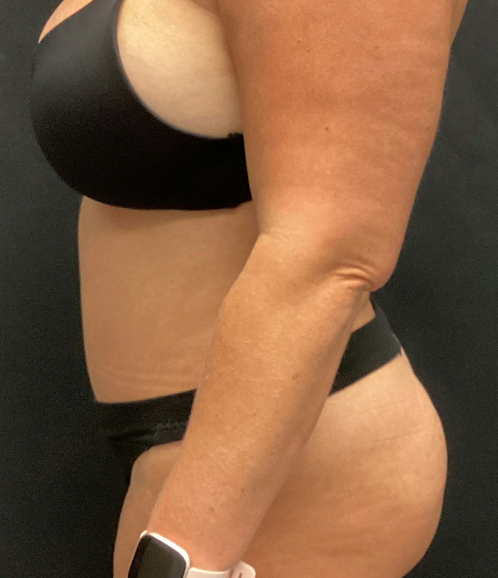 Tummy Tuck Before & After Gallery - Patient 72237389 - Image 6