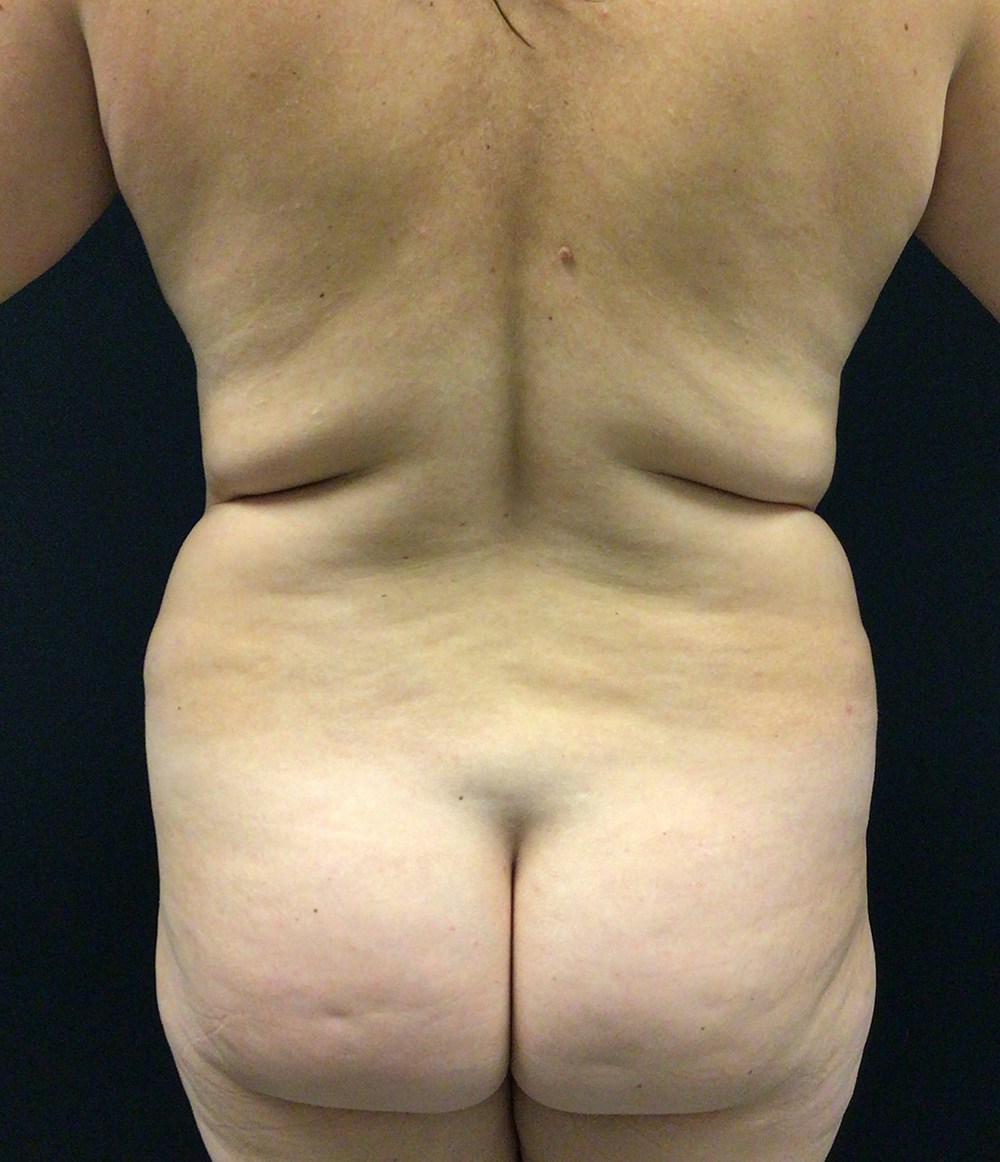 Liposuction Before & After Gallery - Patient 72237404 - Image 7