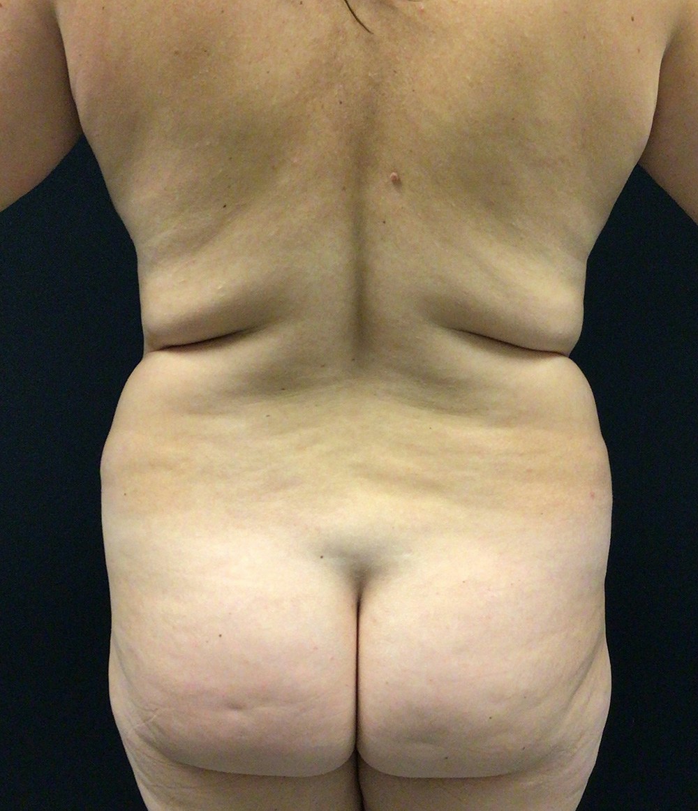 Lipo 360 Before & After Gallery - Patient 72237404 - Image 7