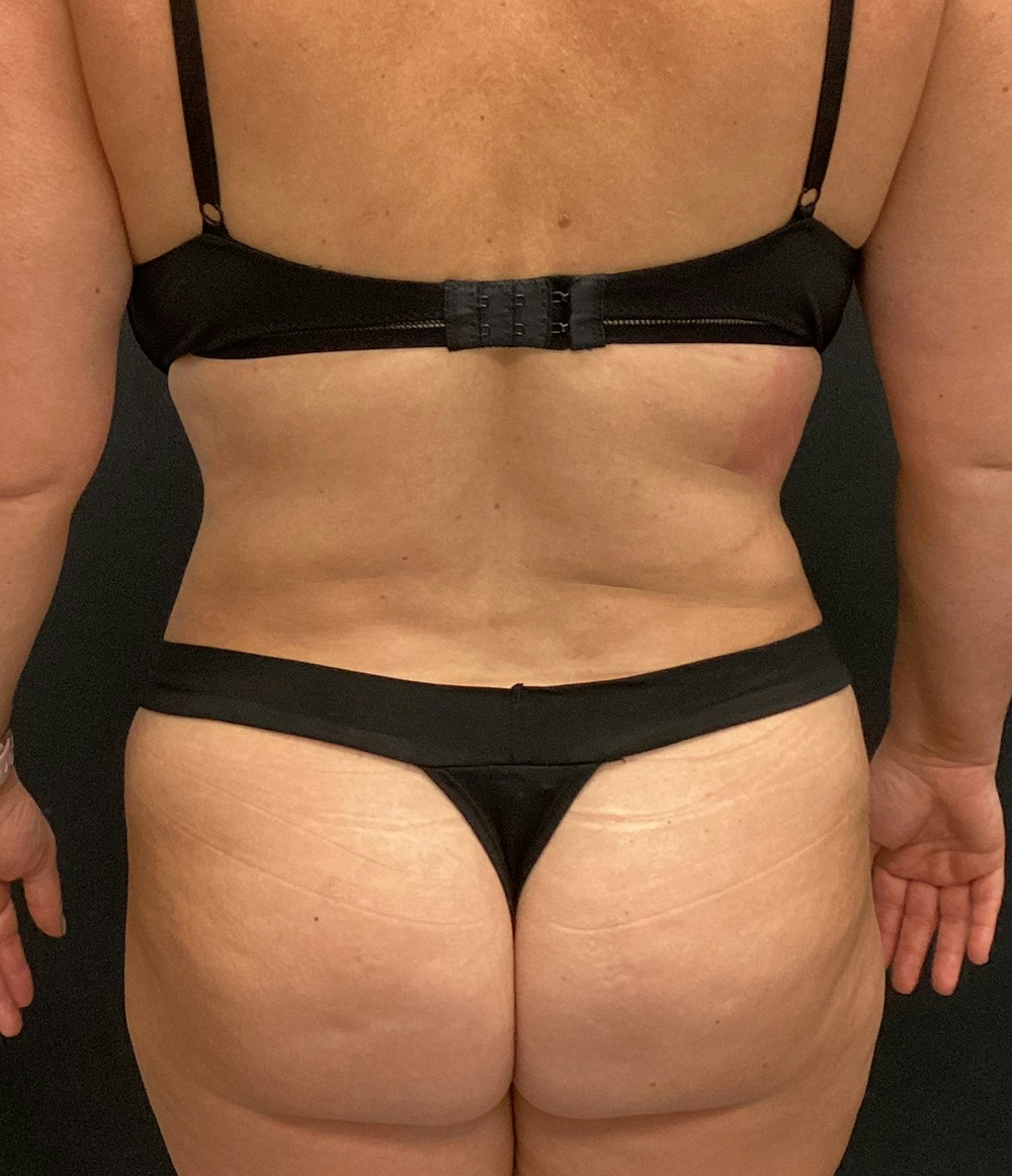Lipo 360 Before & After Gallery - Patient 72237404 - Image 8