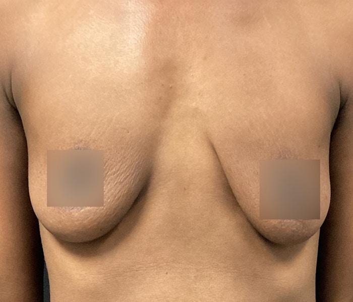 Breast Augmentation Before & After Gallery - Patient 72243254 - Image 1
