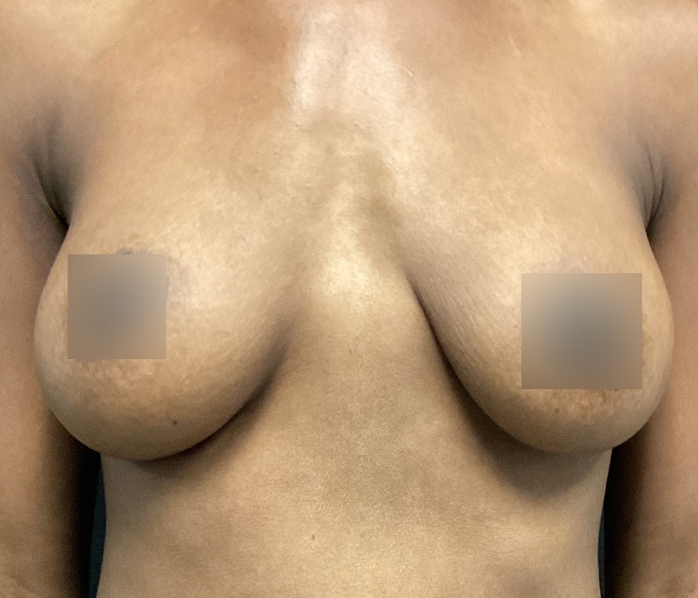 Breast Augmentation Before & After Gallery - Patient 72243254 - Image 2