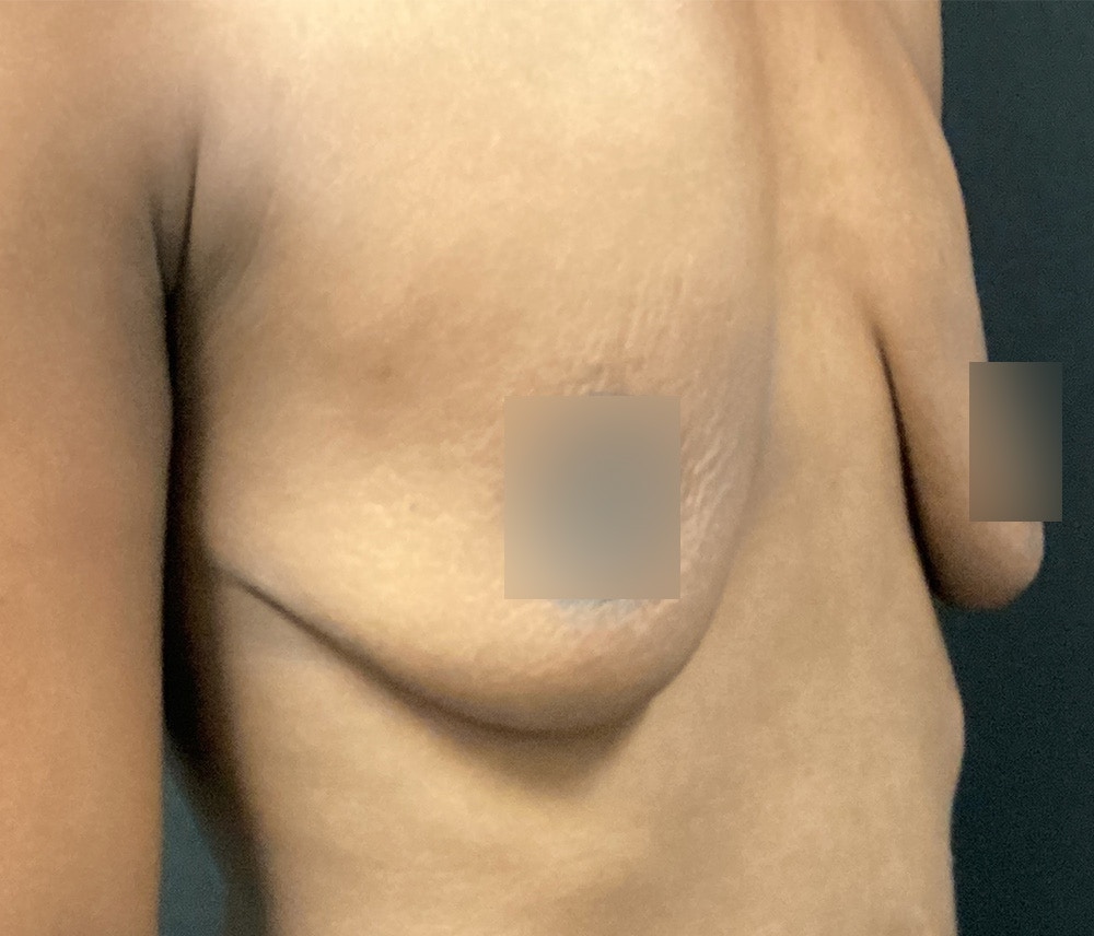 Breast Augmentation Before & After Gallery - Patient 72243254 - Image 3