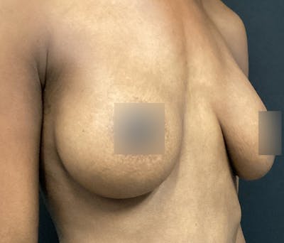 Breast Augmentation Before & After Gallery - Patient 72243254 - Image 4