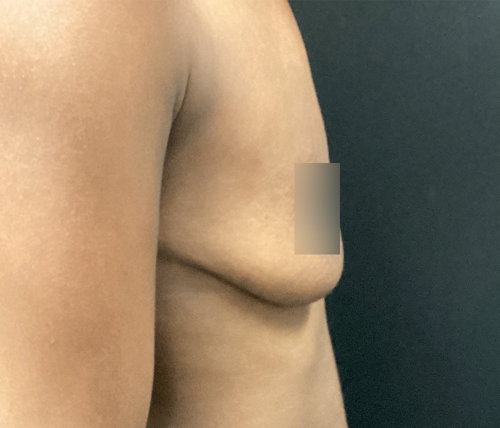 Breast Augmentation Before & After Gallery - Patient 72243254 - Image 5