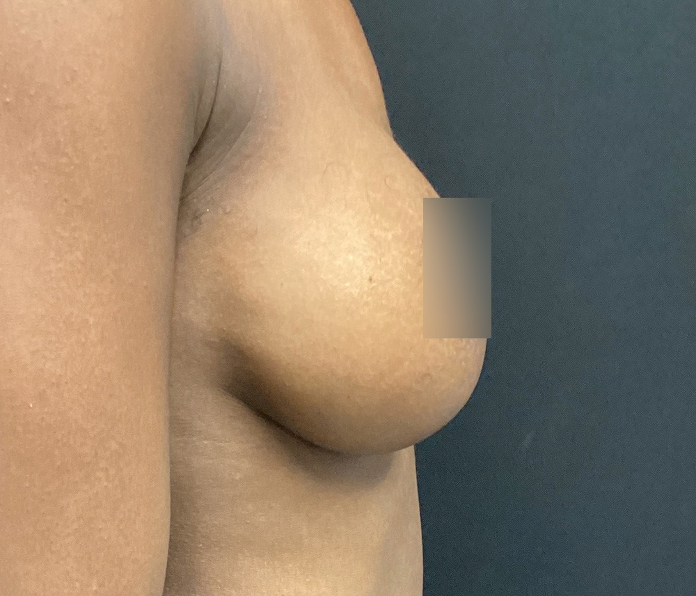 Breast Augmentation Before & After Gallery - Patient 72243254 - Image 6