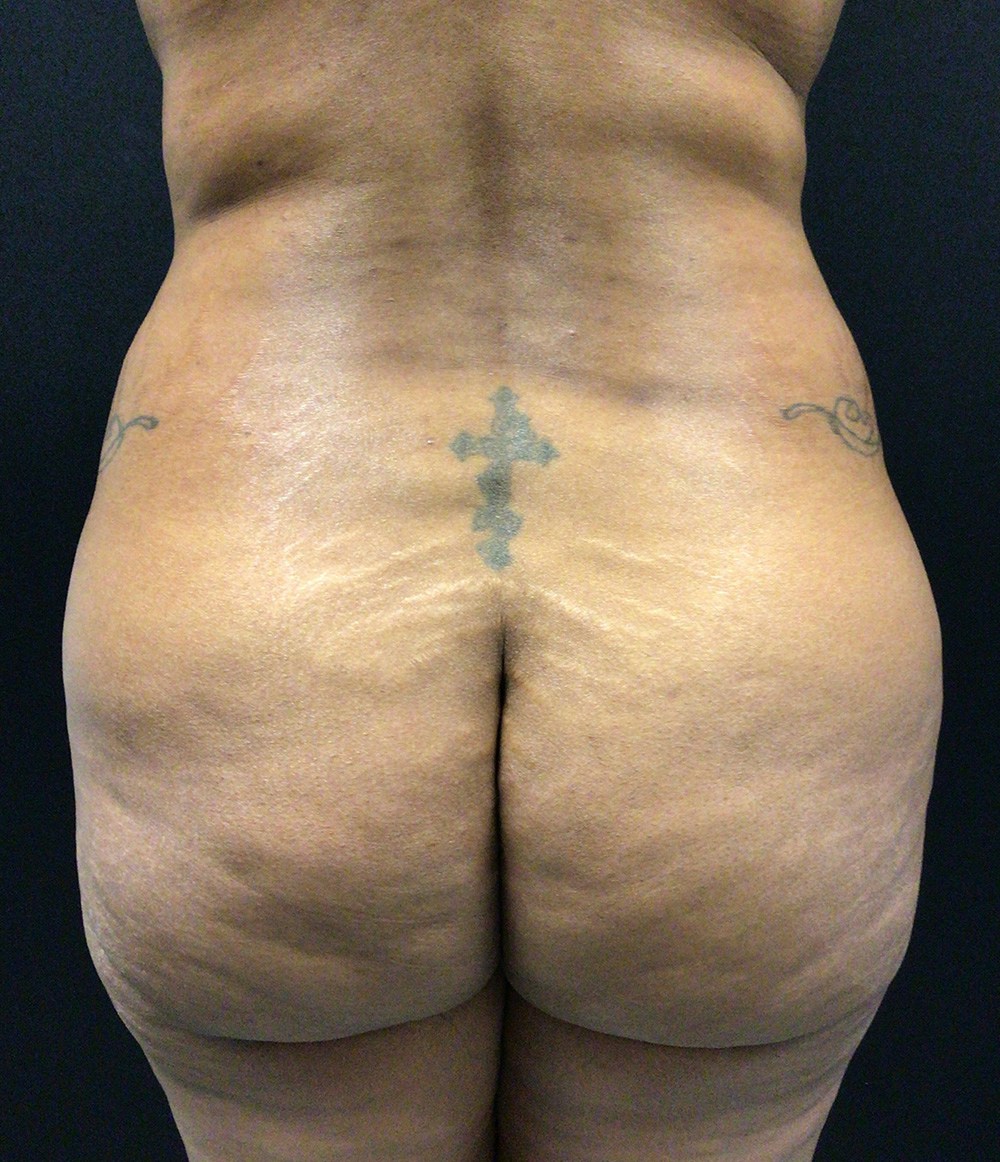 Liposuction Before & After Gallery - Patient 89193885 - Image 1
