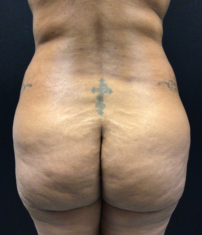 Brazilian Butt Lift Before & After Gallery - Patient 72243259 - Image 1