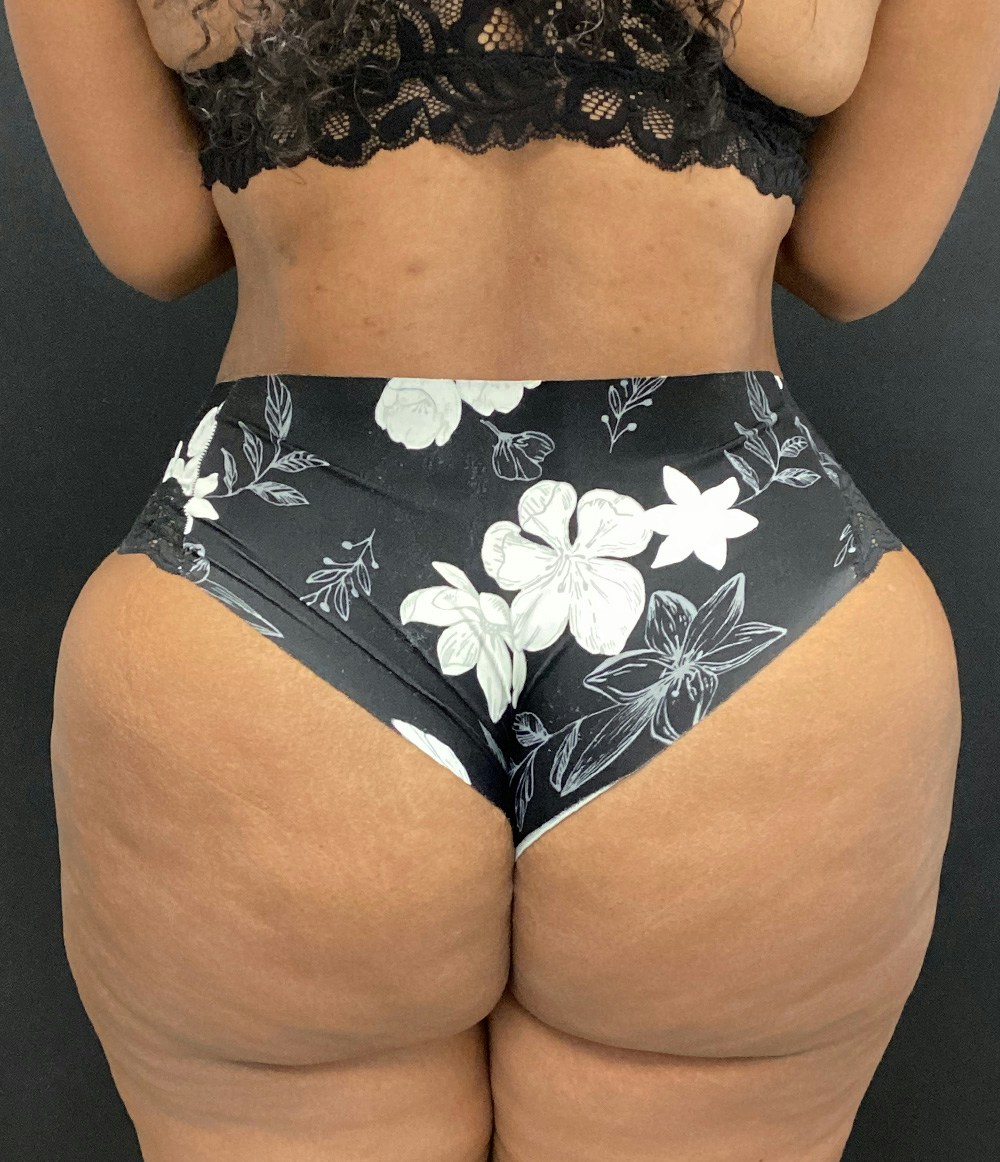 Lipo 360 Before & After Gallery - Patient 89193885 - Image 2