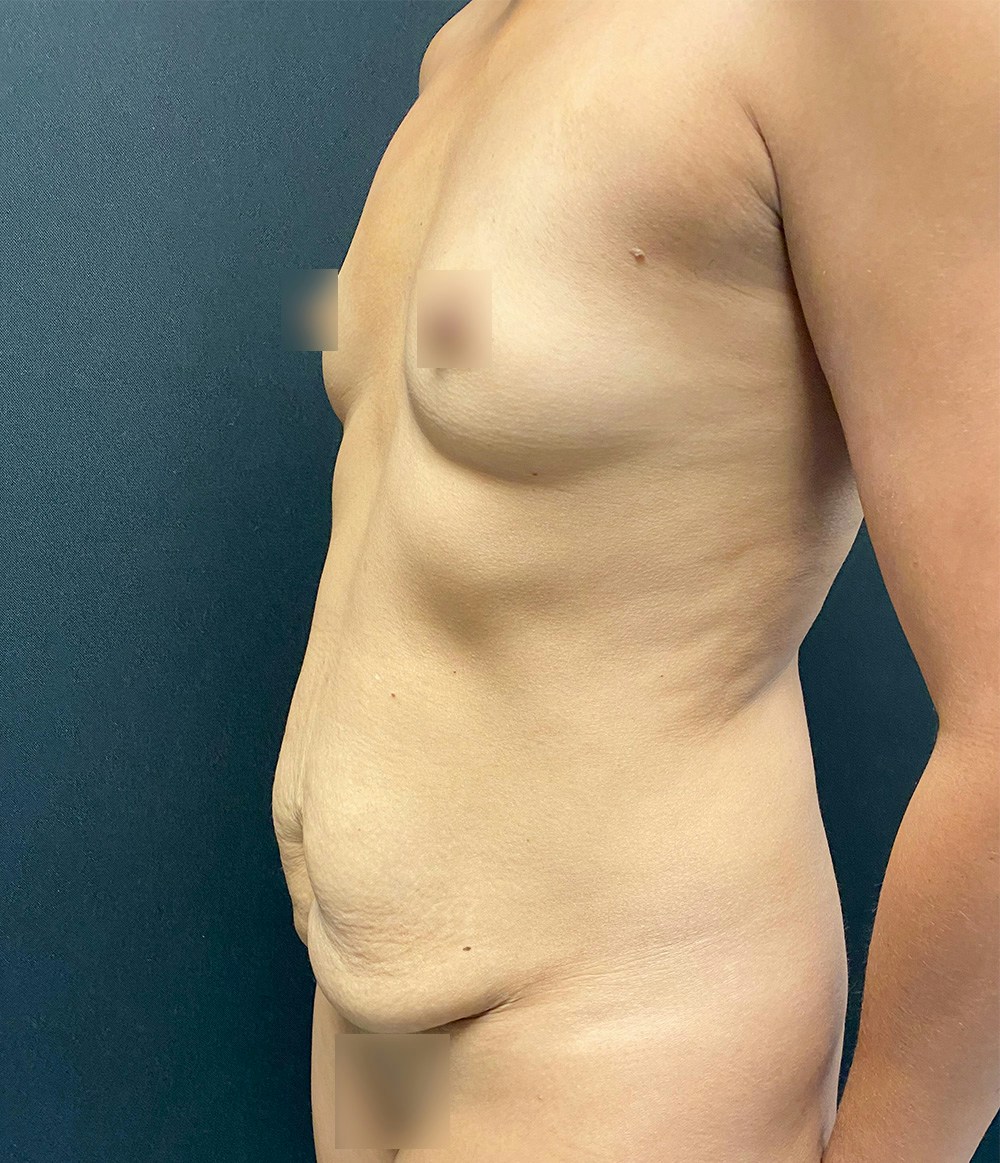 Tummy Tuck Before & After Gallery - Patient 77487936 - Image 3