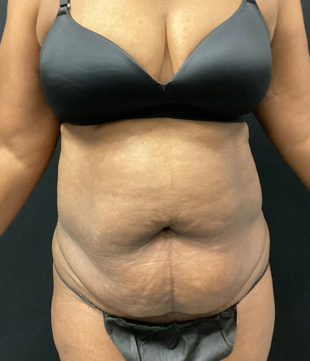 Liposuction Before & After Gallery - Patient 89193832 - Image 1
