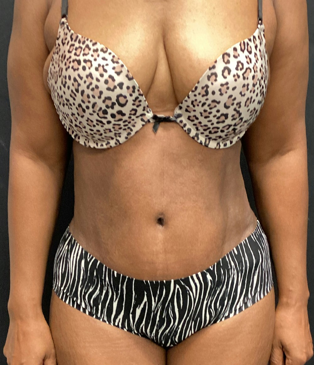 Liposuction Before & After Gallery - Patient 89193832 - Image 2
