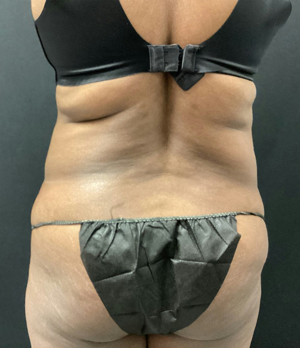 Liposuction Before & After Gallery - Patient 89193832 - Image 7