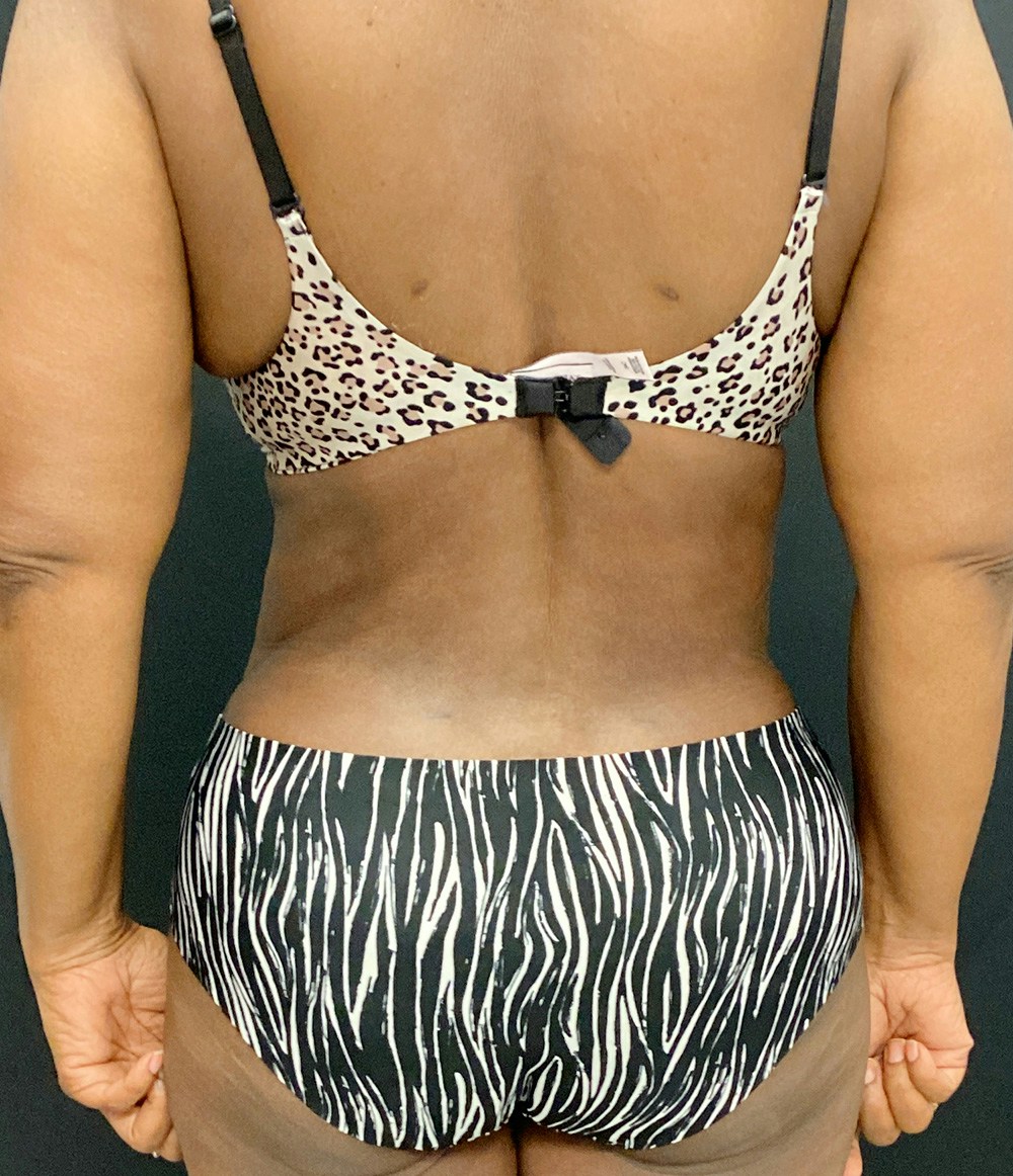 Liposuction Before & After Gallery - Patient 89193832 - Image 8