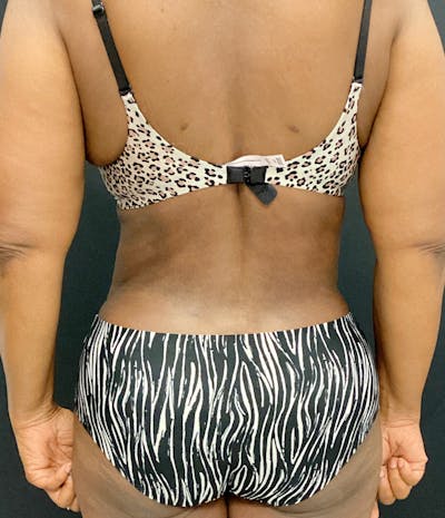 Liposuction Before & After Gallery - Patient 89193832 - Image 8
