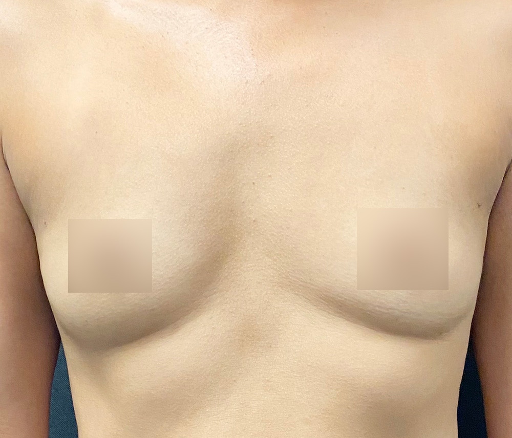 Breast Augmentation Before & After Gallery - Patient 77487943 - Image 1