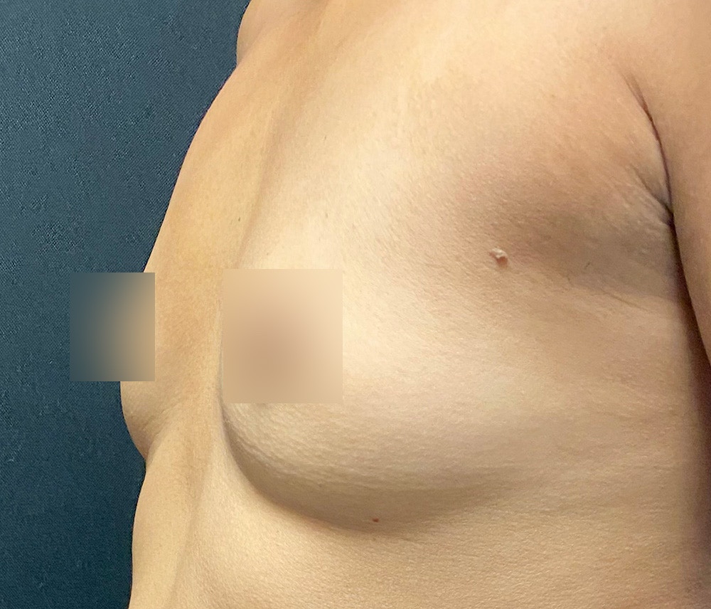 Breast Augmentation Before & After Gallery - Patient 77487943 - Image 3