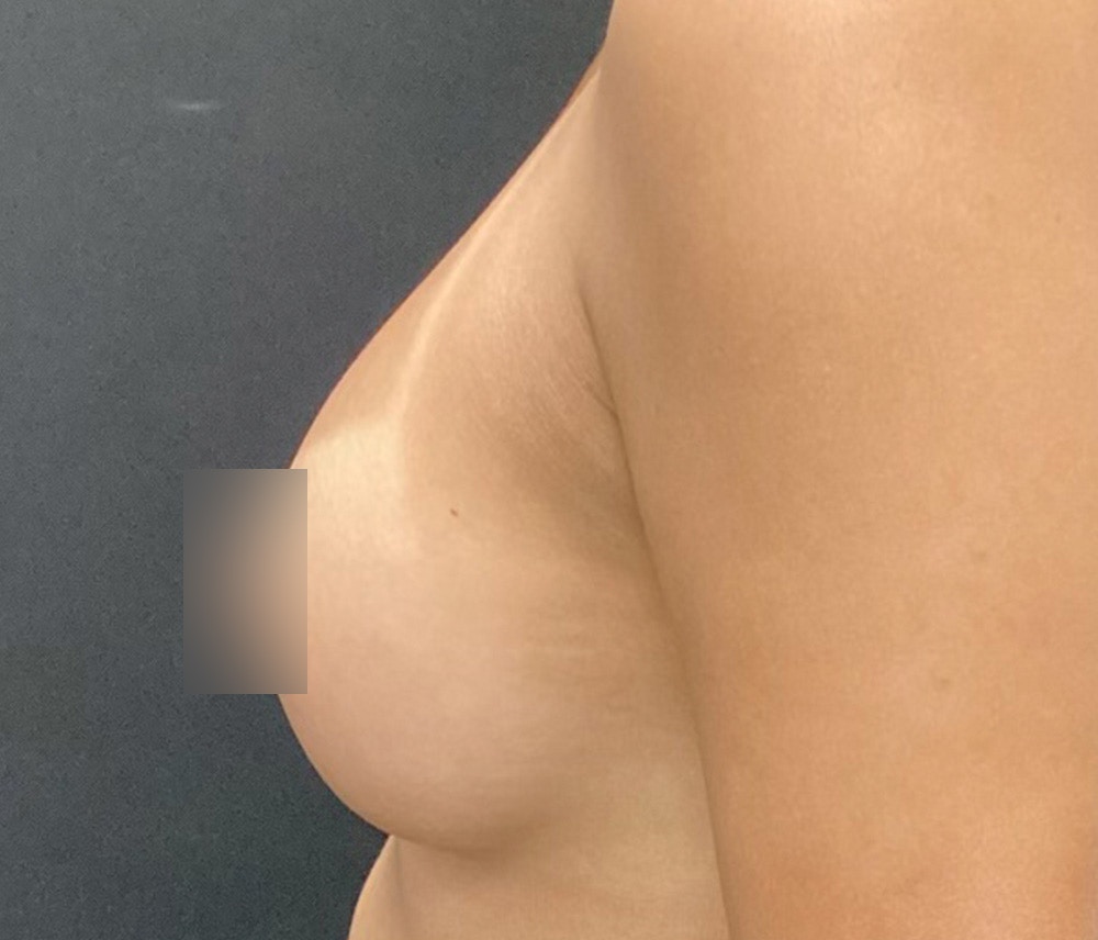 Breast Augmentation Before & After Gallery - Patient 77487943 - Image 4