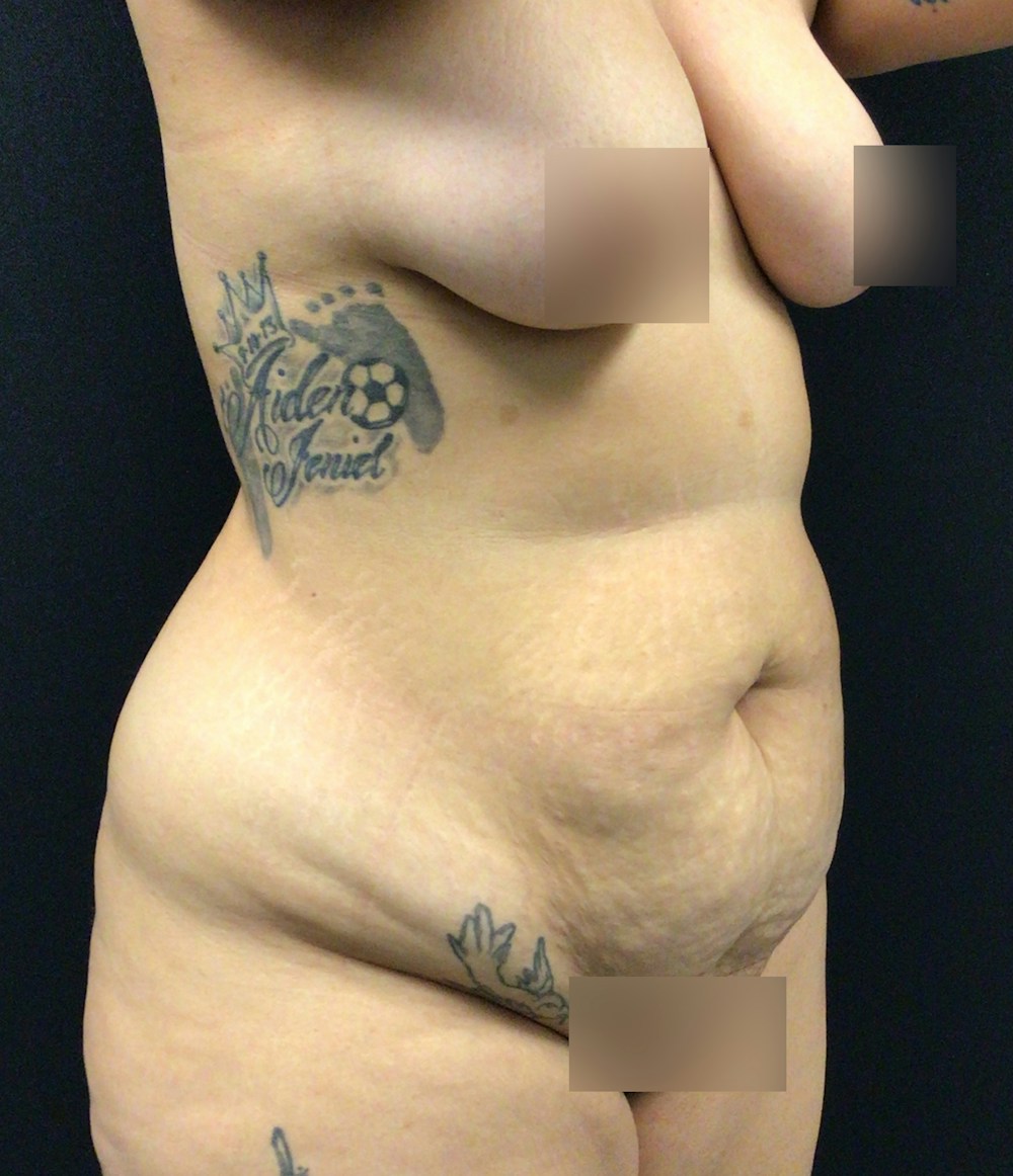 Liposuction Before & After Gallery - Patient 89193674 - Image 3