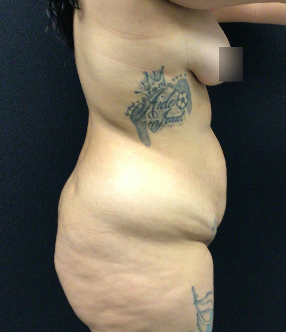 Liposuction Before & After Gallery - Patient 89193674 - Image 5