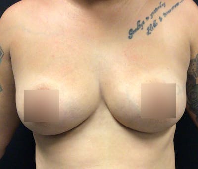 Breast Augmentation Before & After Gallery - Patient 91432977 - Image 1