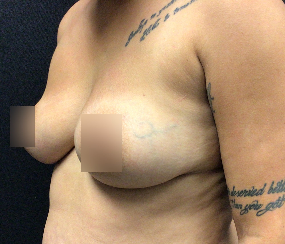 Breast Augmentation Before & After Gallery - Patient 91432977 - Image 3