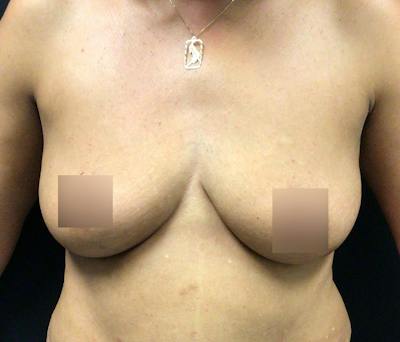 Breast Augmentation Before & After Gallery - Patient 91433142 - Image 1
