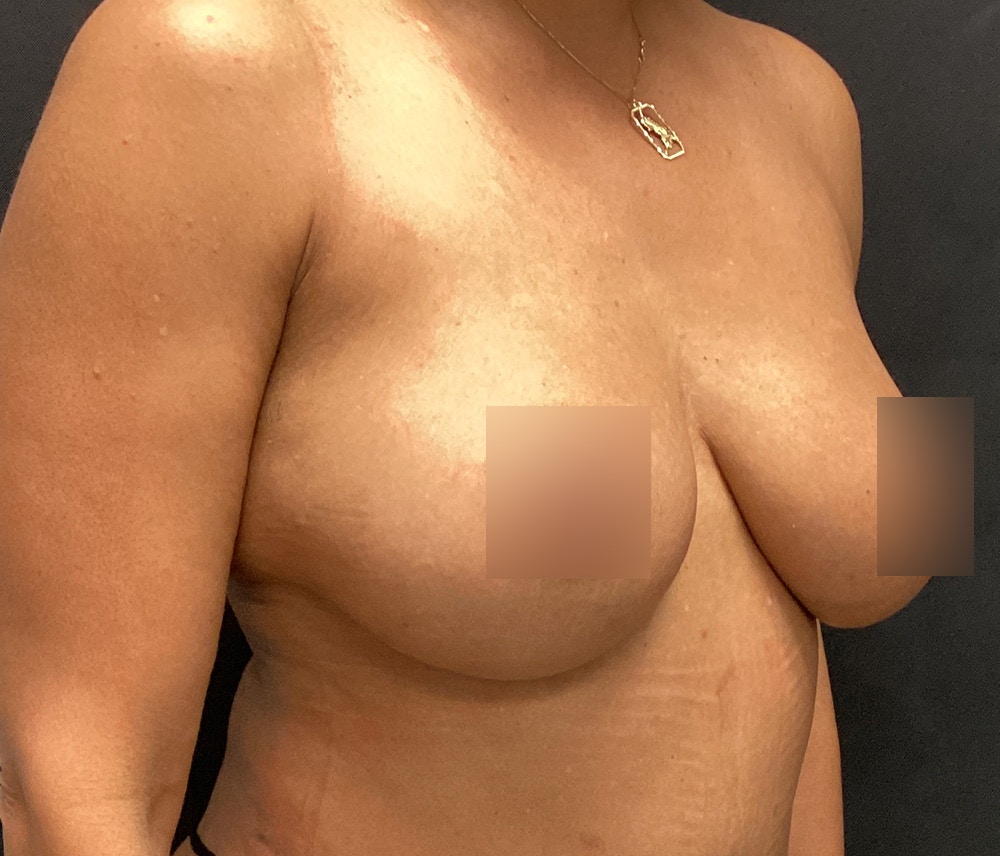 Breast Augmentation Before & After Gallery - Patient 91433142 - Image 4