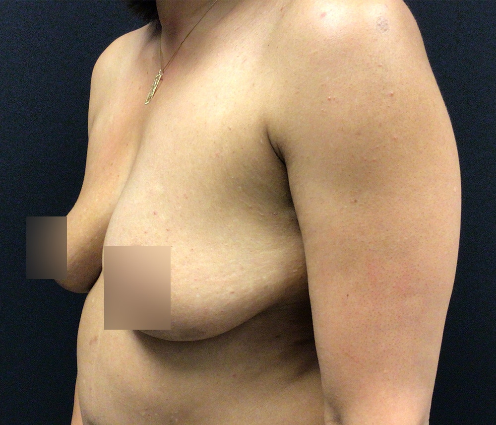 Breast Augmentation Before & After Gallery - Patient 91433142 - Image 5