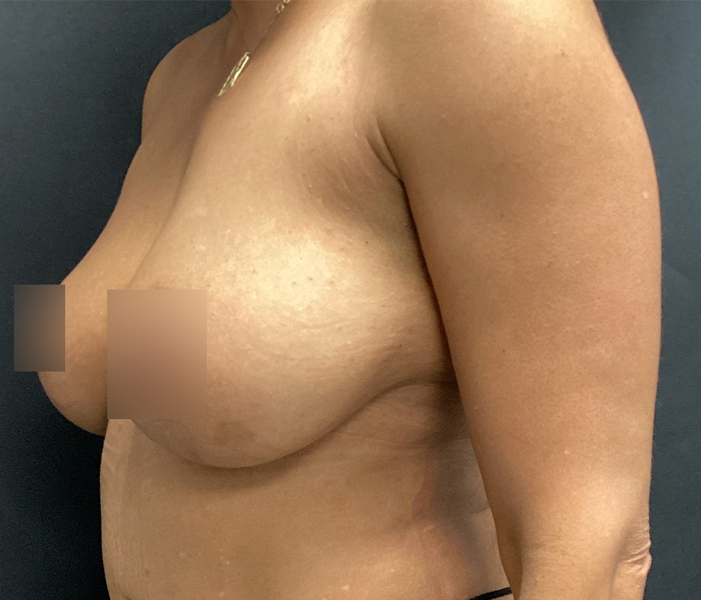 Breast Augmentation Before & After Gallery - Patient 91433142 - Image 6