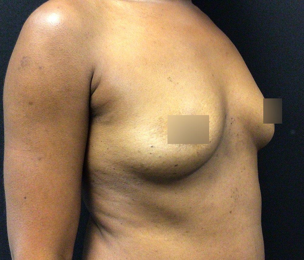 Breast Augmentation Before & After Gallery - Patient 62153201 - Image 5