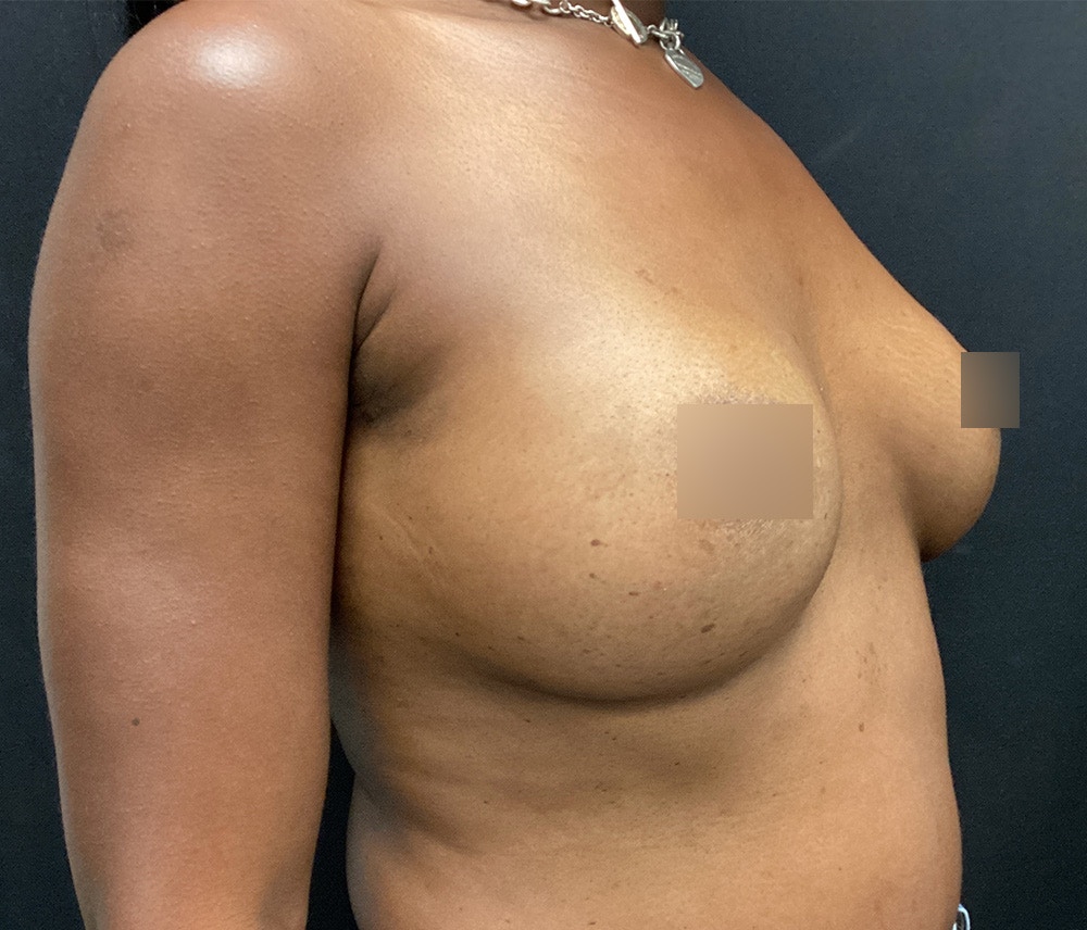 Breast Augmentation Before & After Gallery - Patient 62153201 - Image 6