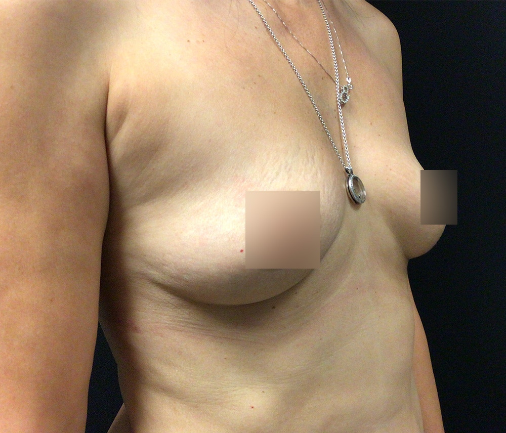Breast Augmentation Before & After Gallery - Patient 62150387 - Image 5