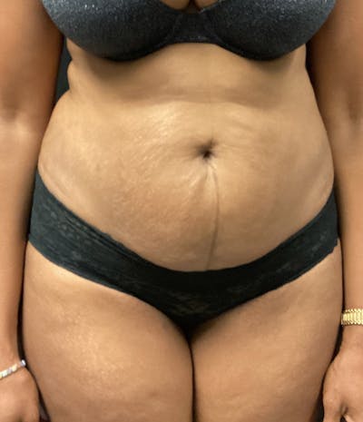 Brazilian Butt Lift Before & After Gallery - Patient 91438693 - Image 3