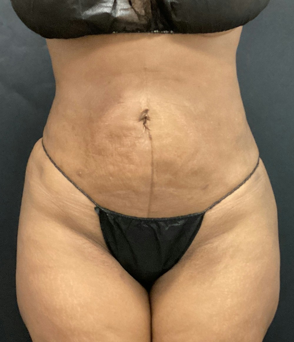 Brazilian Butt Lift Before & After Gallery - Patient 91438693 - Image 4