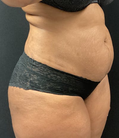 Brazilian Butt Lift Before & After Gallery - Patient 91438693 - Image 5