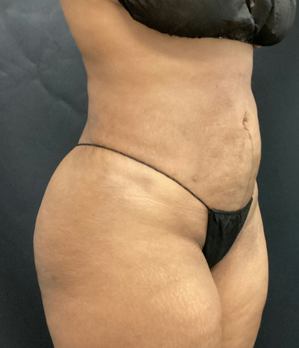 Brazilian Butt Lift Before & After Gallery - Patient 91438693 - Image 6