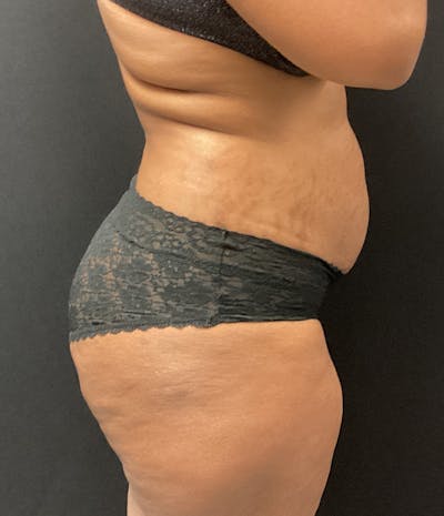 Brazilian Butt Lift Before & After Gallery - Patient 91438693 - Image 7