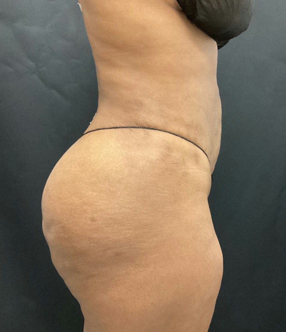 Brazilian Butt Lift Before & After Gallery - Patient 91438693 - Image 8