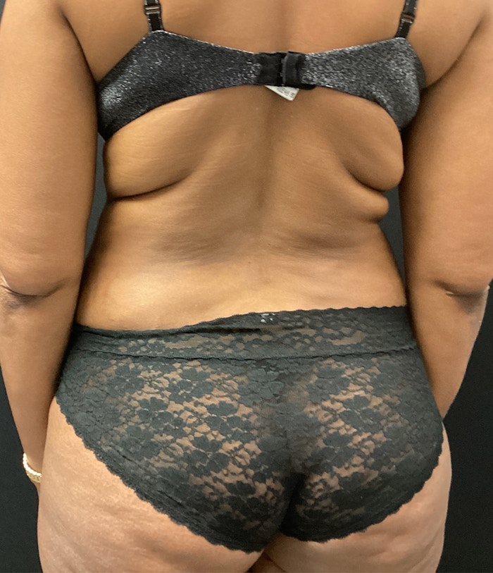 Brazilian Butt Lift Before & After Gallery - Patient 91438693 - Image 1
