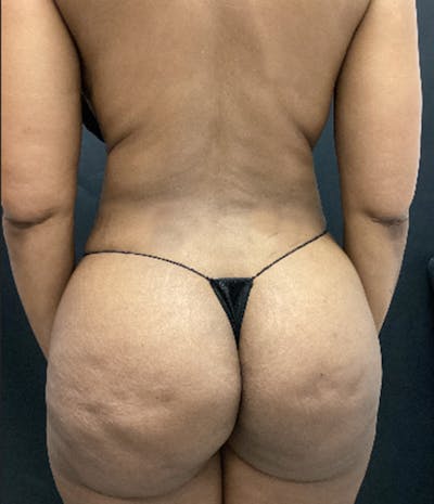 Brazilian Butt Lift Before & After Gallery - Patient 91438693 - Image 2
