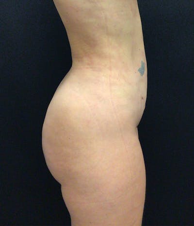 Brazilian Butt Lift Before & After Gallery - Patient 91438701 - Image 4