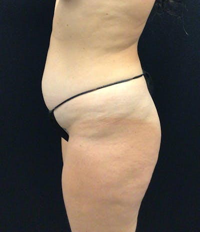 Brazilian Butt Lift Before & After Gallery - Patient 91438701 - Image 5