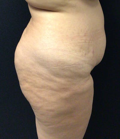 Brazilian Butt Lift Before & After Gallery - Patient 58243813 - Image 5