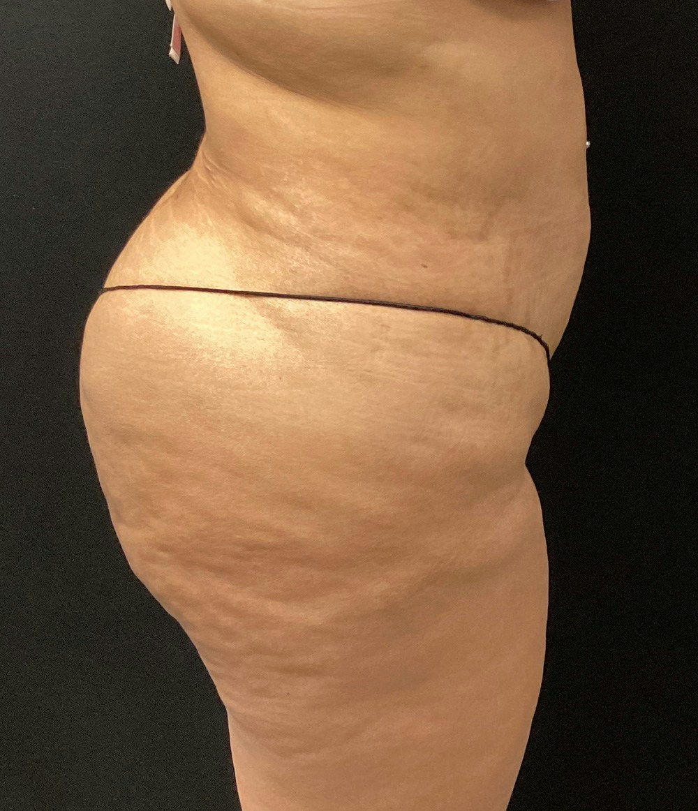 Brazilian Butt Lift Before & After Gallery - Patient 58243813 - Image 6