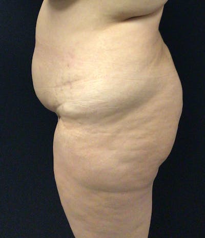 Brazilian Butt Lift Before & After Gallery - Patient 58243813 - Image 7