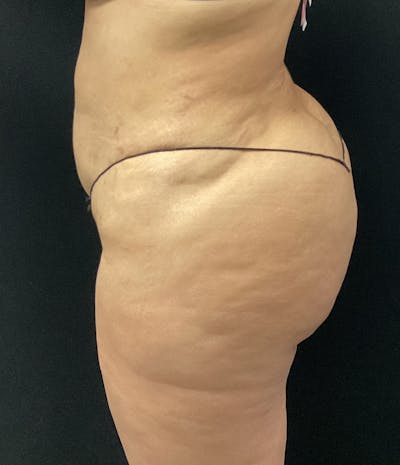 Brazilian Butt Lift Before & After Gallery - Patient 58243813 - Image 8